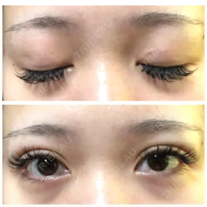 二重埋没 城本クリニック 立川院 DAY 40 メイン用