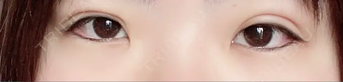 二重埋没 城本クリニック 豊橋院 DAY 4 メイン用