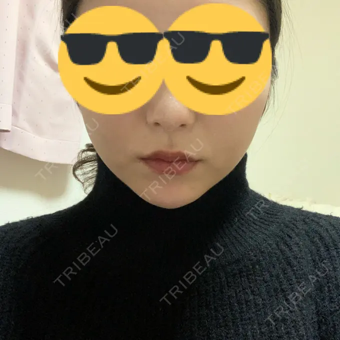 ヒアルロン酸注入（あご） TCB東京中央美容外科 池袋西口院 DAY 0 メイン用