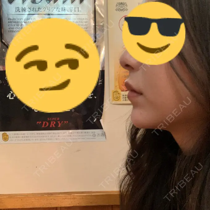 ヒアルロン酸注入（あご） TCB東京中央美容外科 池袋西口院 DAY 0 メイン用