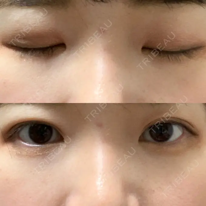 二重埋没 湘南美容クリニック 東京蒲田院 DAY 22 メイン用