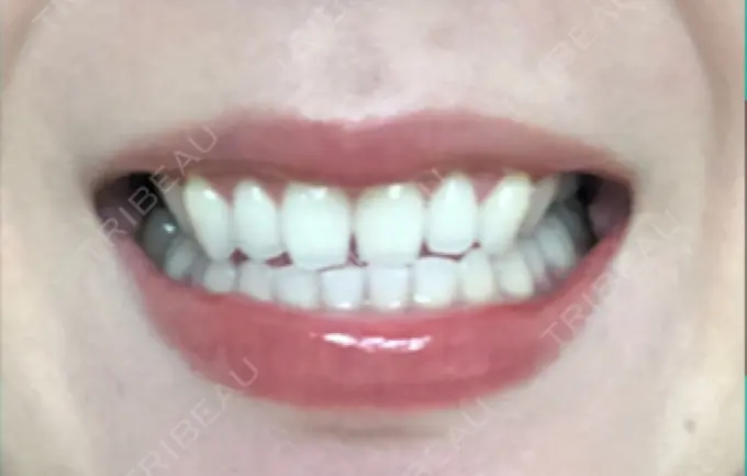 その他（審美歯科/矯正歯科） 南青山矯正歯科 DAY 58 メイン用