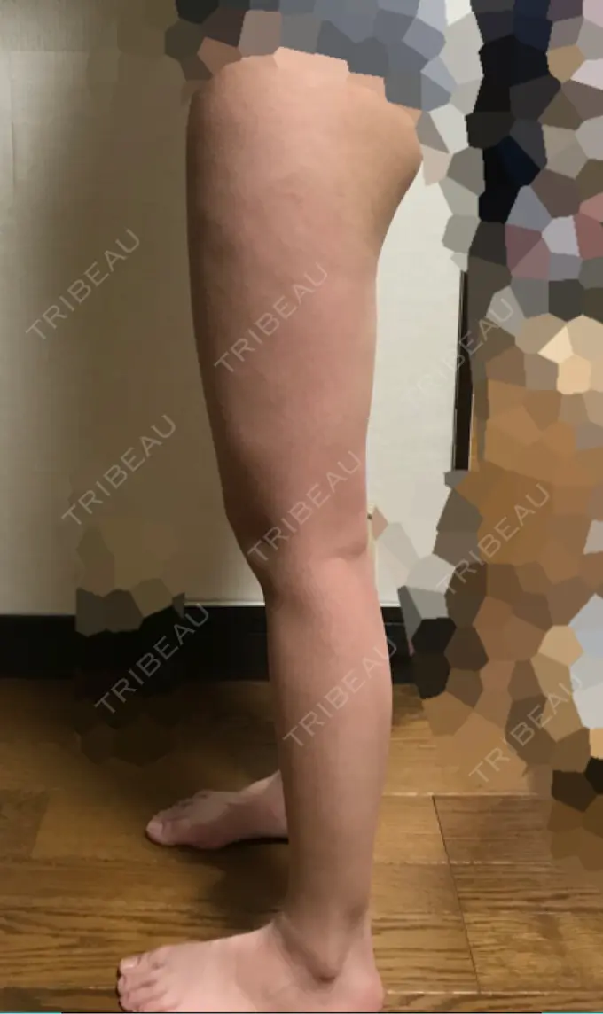 脂肪吸引（脚） / 豊胸（脂肪注入） ドクターフィット（Dr.fit）クリニック DAY 62 メイン用