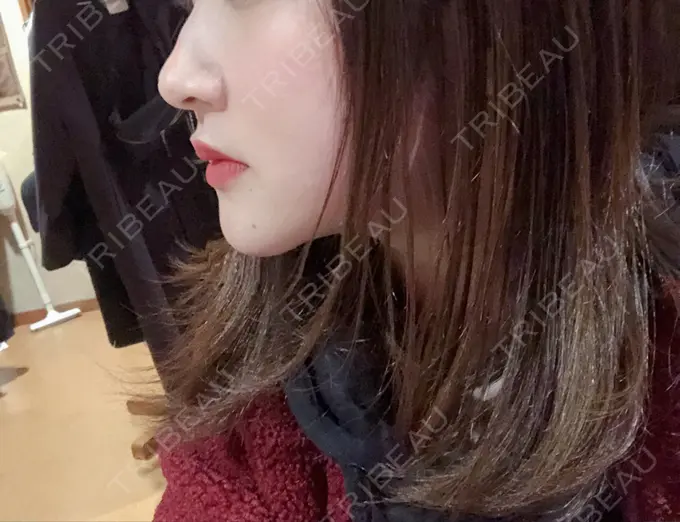 骨切り（あご） / ルフォー+ssro（両あご) 東京美容外科 赤坂院 DAY 218 メイン用