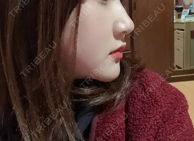 骨切り（あご） / ルフォー+ssro（両あご) 東京美容外科 赤坂院 DAY 218 メイン用