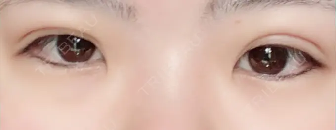 二重埋没 城本クリニック 豊橋院 DAY 5 メイン用