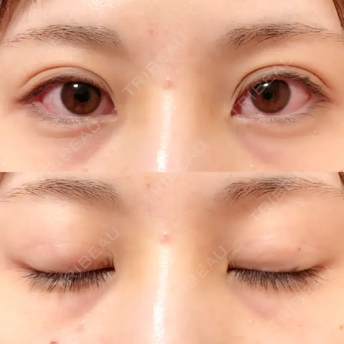 二重切開 / 上まぶたの脂肪取り / その他（目元） 銀座高須クリニック AFTER メイン用