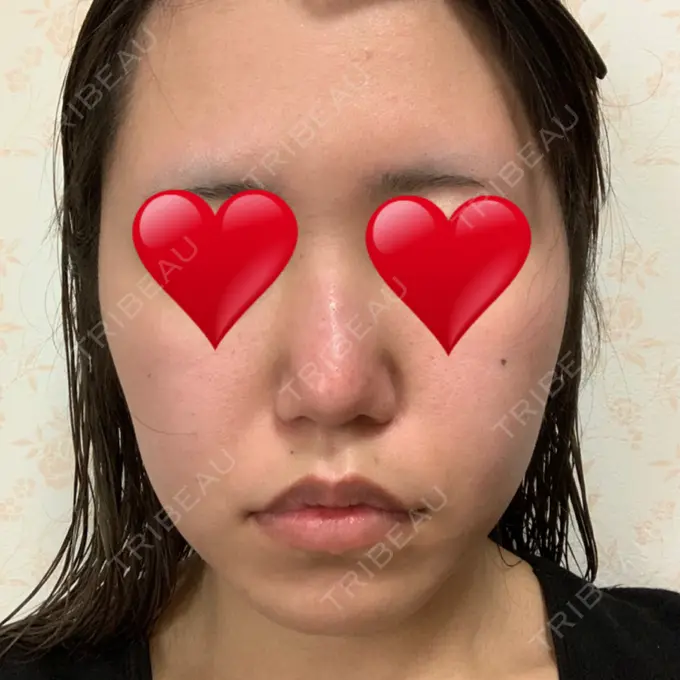 鼻尖形成（切開） / ヒアルロン酸注入（鼻） / その他（鼻） 高崎TAクリニック DAY 16 メイン用