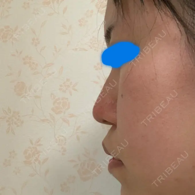鼻尖形成（切開） / ヒアルロン酸注入（鼻） / その他（鼻） 高崎TAクリニック DAY 16 メイン用
