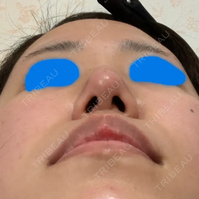 鼻尖形成（切開） / ヒアルロン酸注入（鼻） / その他（鼻） 高崎TAクリニック DAY 16 メイン用