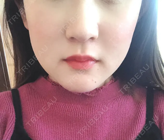 骨切り（あご） / ルフォー+ssro（両あご) 東京美容外科 赤坂院 AFTER メイン用