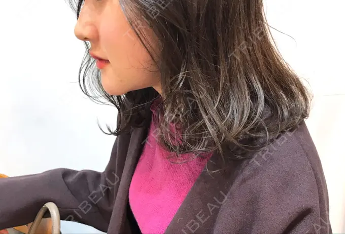 骨切り（あご） / ルフォー+ssro（両あご) 東京美容外科 赤坂院 DAY 233 メイン用