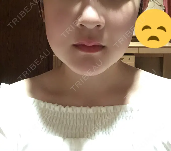 骨切り（あご） / ルフォー+ssro（両あご) 東京美容外科 赤坂院 DAY 100 メイン用