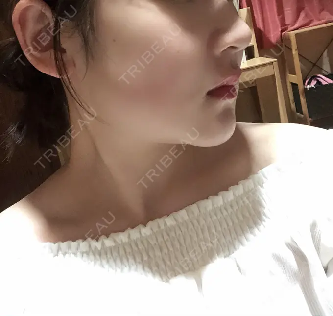 骨切り（あご） / ルフォー+ssro（両あご) 東京美容外科 赤坂院 DAY 100 メイン用