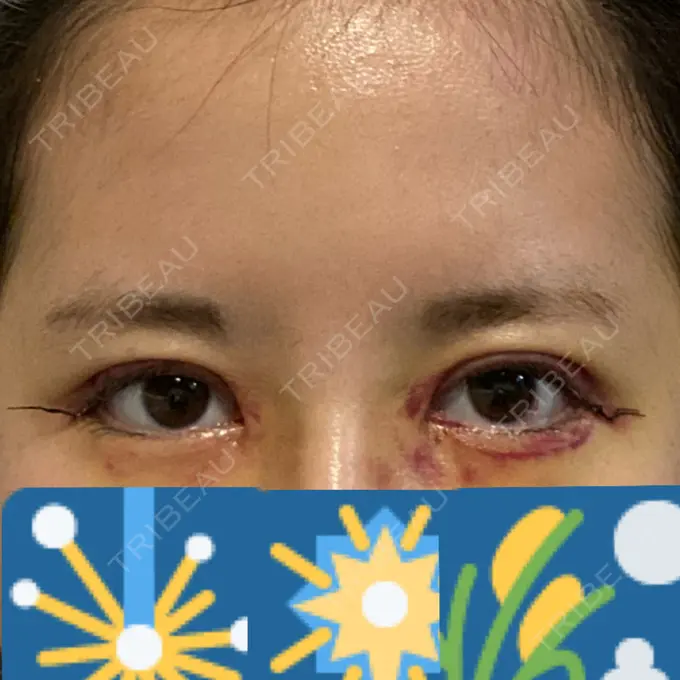 二重切開 / 目頭切開 / 眼瞼下垂（切開） / 目尻切開 RG整形外科（旧リオン整形外科） DAY 6 メイン用