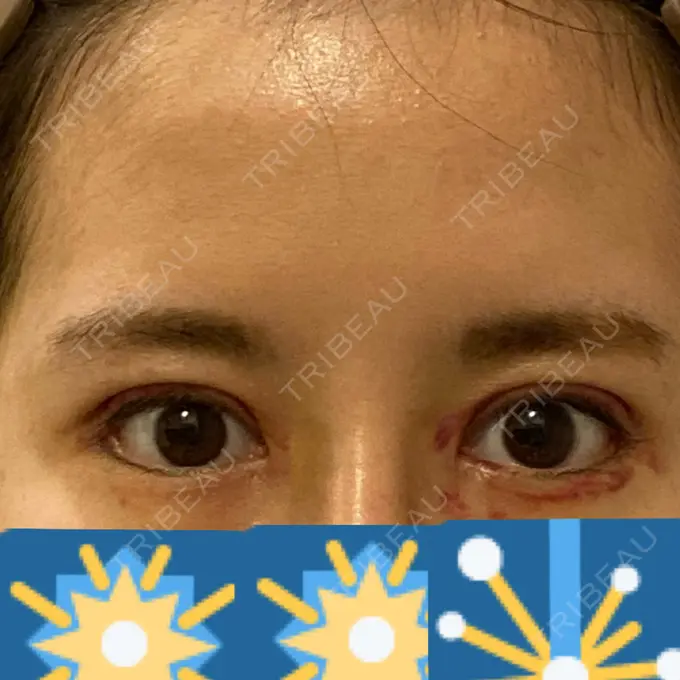 二重切開 / 目頭切開 / 眼瞼下垂（切開） / 目尻切開 RG整形外科（旧リオン整形外科） DAY 9 メイン用