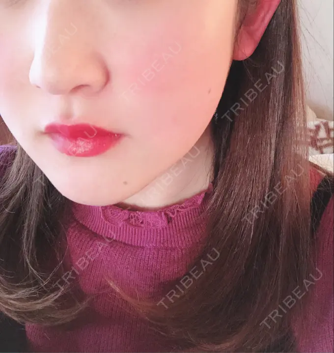 骨切り（あご） / ルフォー+ssro（両あご) 東京美容外科 赤坂院 DAY 304 メイン用