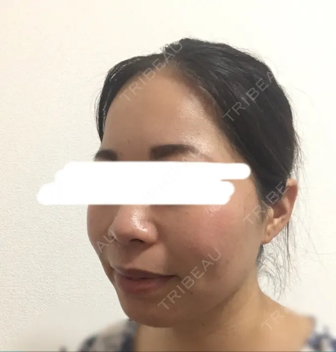 ボトックス（エラ・小顔） Wクリニック 心斎橋院 AFTER メイン用