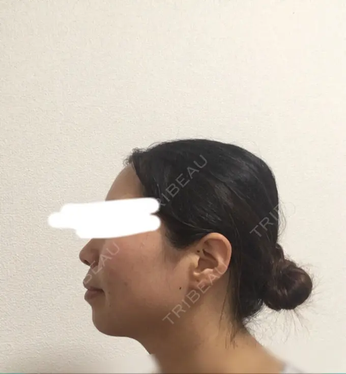 ボトックス（エラ・小顔） Wクリニック 心斎橋院 DAY 7 メイン用