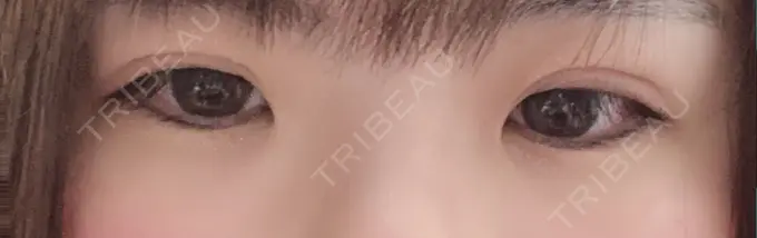 二重埋没 城本クリニック 豊橋院 DAY 6 メイン用