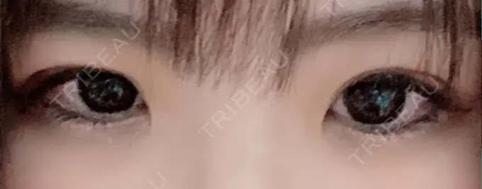 二重埋没 城本クリニック 豊橋院 DAY 6 メイン用