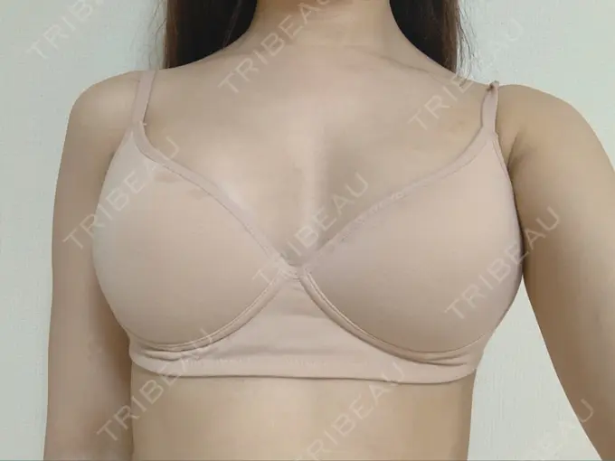 豊胸（シリコンバッグ） ウォンジン（Wonjin）整形外科 DAY 14 メイン用