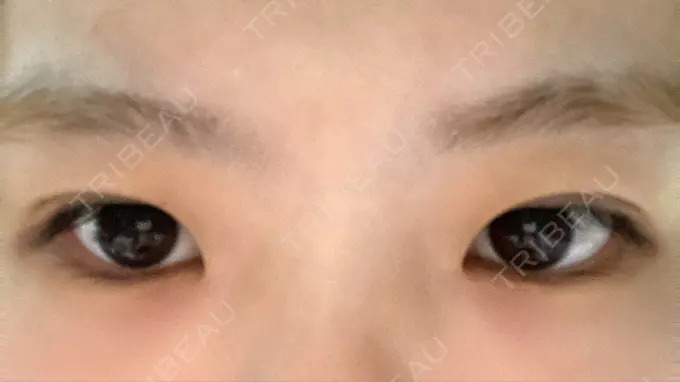 二重切開 きくな湯田眼科 DAY 32 メイン用