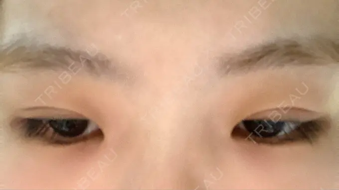 二重切開 きくな湯田眼科 DAY 32 メイン用