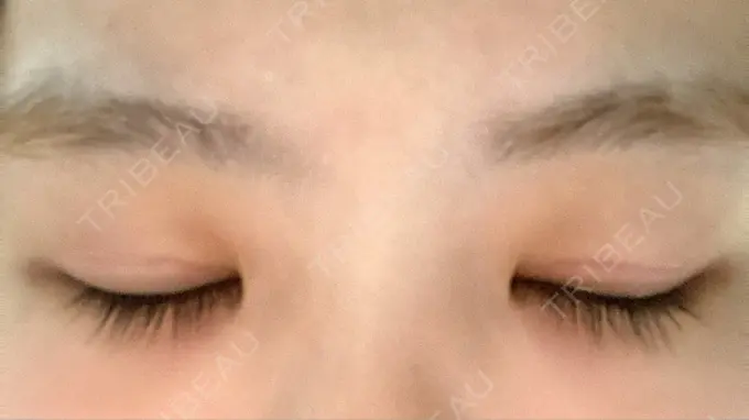 二重切開 きくな湯田眼科 DAY 32 メイン用