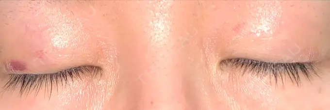 二重埋没 湘南美容クリニック 東京蒲田院 DAY 16 メイン用