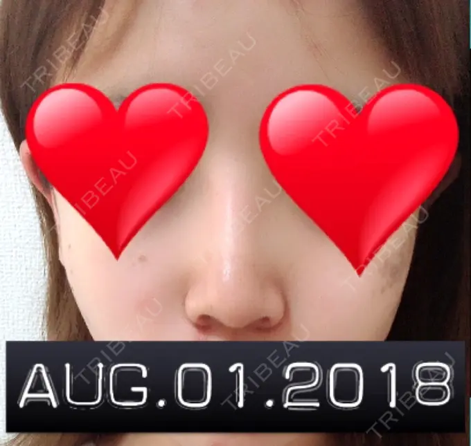 隆鼻術 / 鼻中隔延長（切開） / 軟骨移植 ジュエリー美容外科 AFTER メイン用