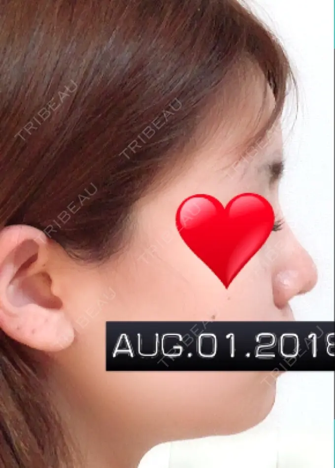 隆鼻術 / 鼻中隔延長（切開） / 軟骨移植 ジュエリー美容外科 DAY 55 メイン用