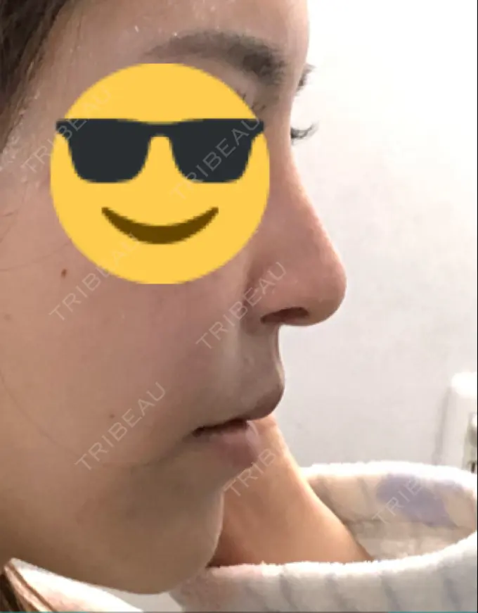 隆鼻術 / 鼻中隔延長（切開） / 軟骨移植 / 骨切幅寄せ / プロテーゼ除去 / 鼻修正 / 真皮移植 / 鼻孔縁下降 KOKO整形外科 DAY 62 メイン用