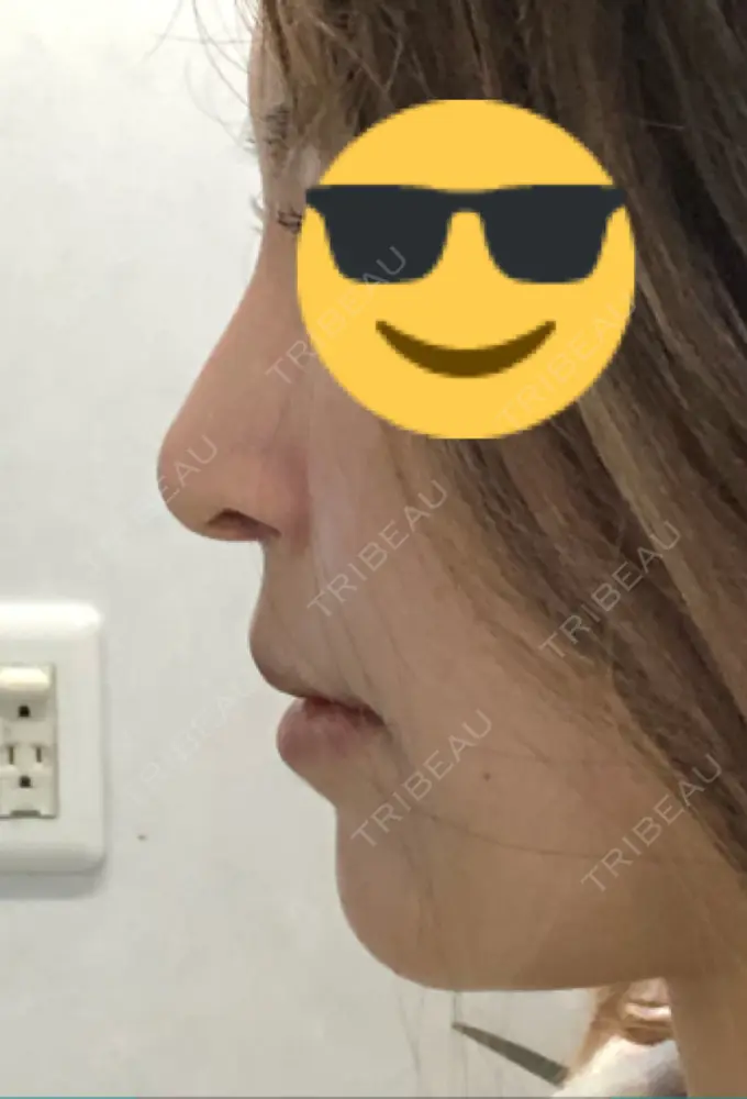 隆鼻術 / 鼻中隔延長（切開） / 軟骨移植 / 骨切幅寄せ / プロテーゼ除去 / 鼻修正 / 真皮移植 / 鼻孔縁下降 KOKO整形外科 DAY 62 メイン用