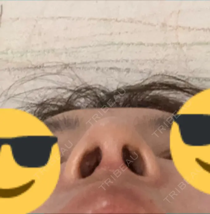 隆鼻術 / 鼻中隔延長（切開） / 軟骨移植 / 骨切幅寄せ / プロテーゼ除去 / 鼻修正 / 真皮移植 / 鼻孔縁下降 KOKO整形外科 DAY 62 メイン用