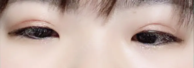 二重埋没 城本クリニック 豊橋院 DAY 9 メイン用