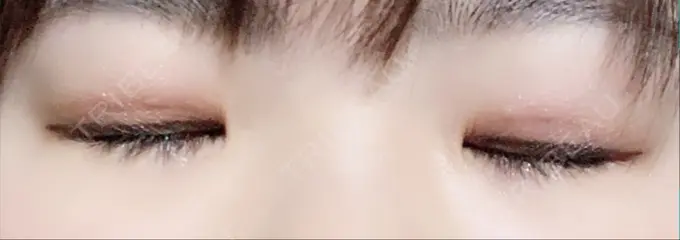 二重埋没 城本クリニック 豊橋院 DAY 9 メイン用