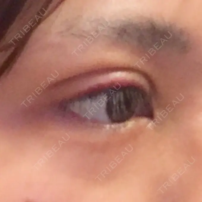 二重埋没 / 上まぶたの脂肪取り 金沢中央クリニック DAY 8 メイン用