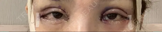 二重埋没 / 目頭切開 / 目尻切開 / タレ目形成・グラマラスライン（切開） RG整形外科（旧リオン整形外科） DAY 0 メイン用