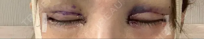 二重埋没 / 目頭切開 / 目尻切開 / タレ目形成・グラマラスライン（切開） RG整形外科（旧リオン整形外科） DAY 0 メイン用