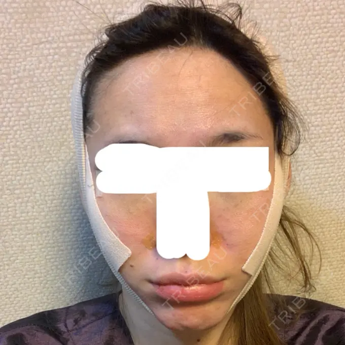 二重埋没 / 目頭切開 / 目尻切開 / タレ目形成・グラマラスライン（切開） RG整形外科（旧リオン整形外科） DAY 0 メイン用