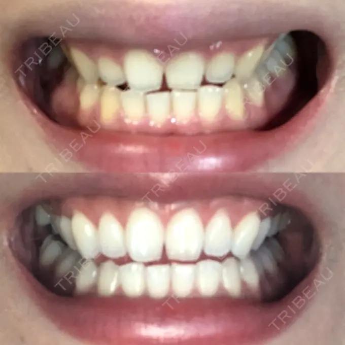 その他（審美歯科/矯正歯科） 南青山矯正歯科 DAY 67 メイン用