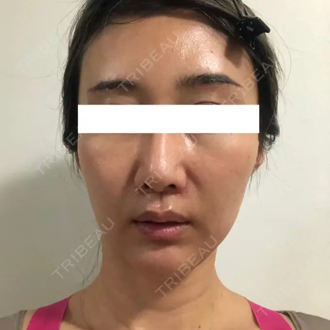 糸リフト / 額を丸く / 人中短縮 / こめかみ形成 / ヒアルロン酸注入（あご） / ボトックス（エラ・小顔） / ヒアルロン酸注入（頬） あきこクリニック DAY 34 メイン用