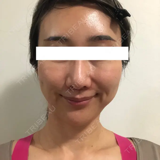 糸リフト / 額を丸く / 人中短縮 / こめかみ形成 / ヒアルロン酸注入（あご） / ボトックス（エラ・小顔） / ヒアルロン酸注入（頬） あきこクリニック DAY 34 メイン用