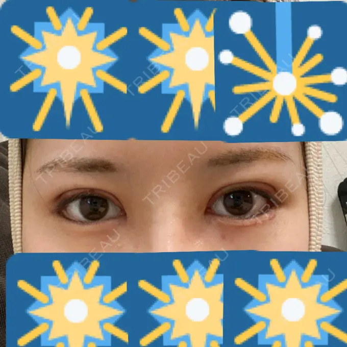 二重切開 / 目頭切開 / 眼瞼下垂（切開） / 目尻切開 RG整形外科（旧リオン整形外科） DAY 14 メイン用