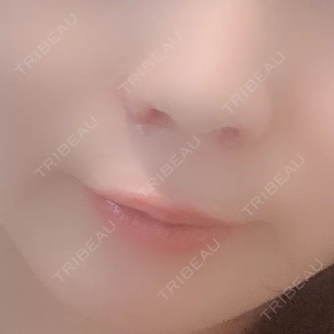 小鼻縮小（切開） / 鼻翼挙上 / 鼻孔縁挙上 大阪TAクリニック DAY 22 メイン用