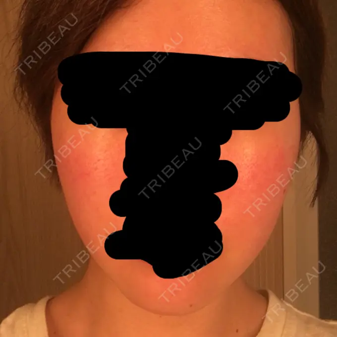 その他（肌） / 再生医療 / PRP皮膚再生療法 聖心美容クリニック 六本木院 DAY 102 メイン用