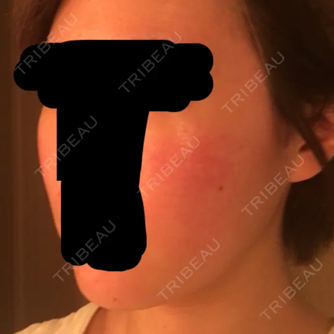 その他（肌） / 再生医療 / PRP皮膚再生療法 聖心美容クリニック 六本木院 DAY 102 メイン用