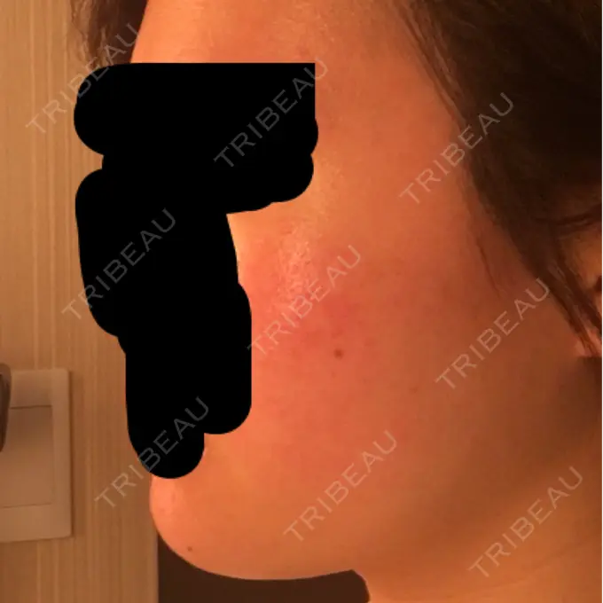 その他（肌） / 再生医療 / PRP皮膚再生療法 聖心美容クリニック 六本木院 DAY 102 メイン用