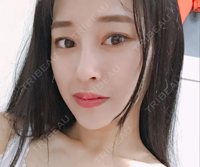 二重埋没 / 隆鼻術 / 豊胸（シリコンバッグ） MIGO（ミゴ）整形外科 DAY 21 メイン用